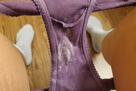 FLUJO VAGINAL BLANCO ESPESO GRUMOSO CANDIDIASIS